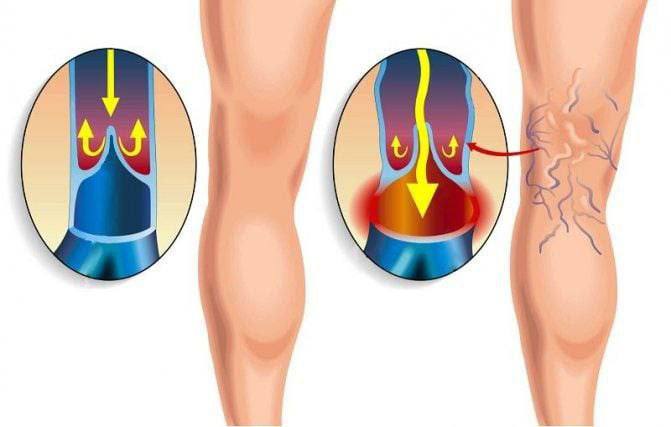 Improve blood circulation in the legs