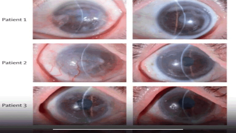 Scientists have restored vision in patients using stem cells