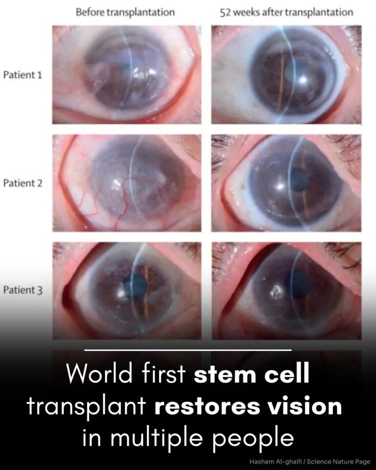 Scientists have restored vision in patients using stem cells