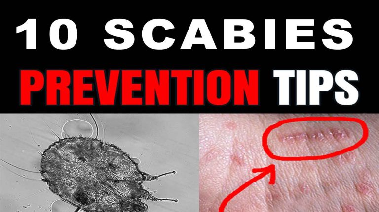 10 Tips Of Scabies Prevention