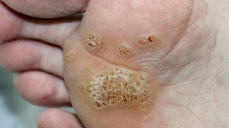 Natural remedy for healing Warts