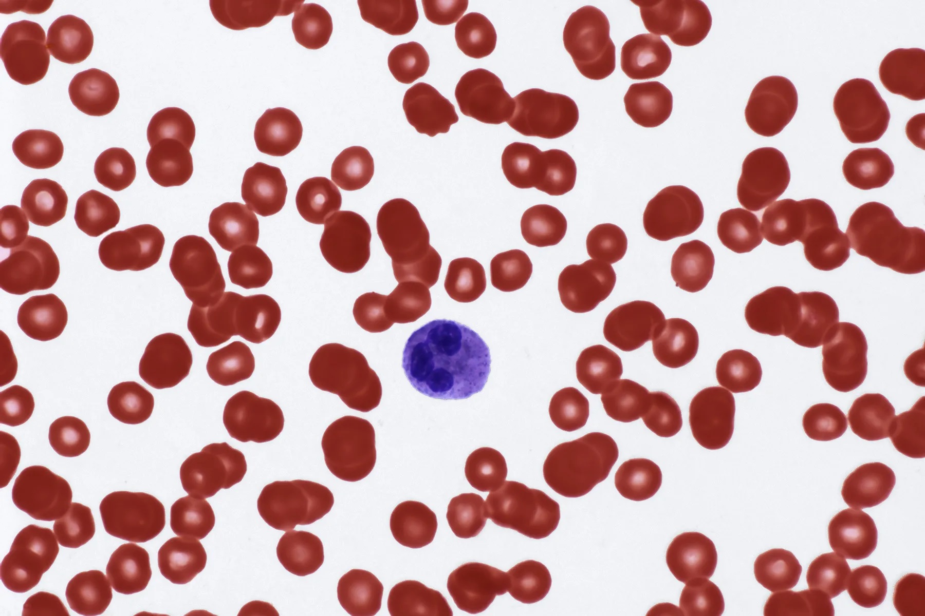High leukocyte levels