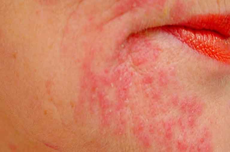 The Irritation of the pores and skin