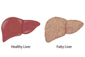 Fatty Liver Disease